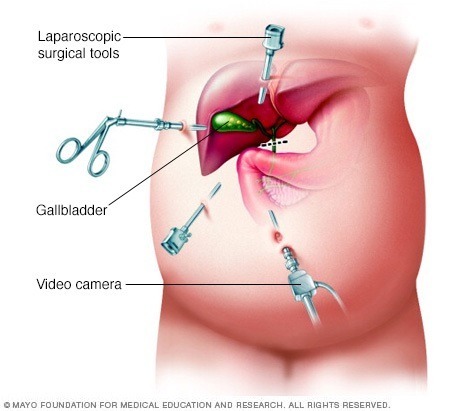 جراحة استئصال المرارة بالمنظار - mayoclinic.org