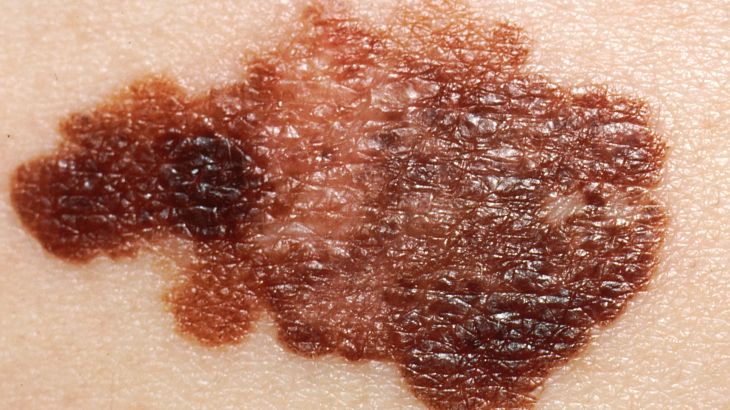 ما الطرق التي تساعدك في السلامة من سرطان الجلد الميلانوما؟