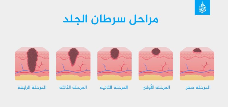 الهواتف المحمولة قد يكون لها دور.. السويد أول دولة أوروبية تشهد تراجعا لسرطان الجلد بين الشباب