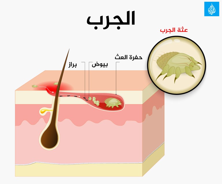 الجرب مرض يشتهر باسم السكابيوس.. الأعراض والعلاج