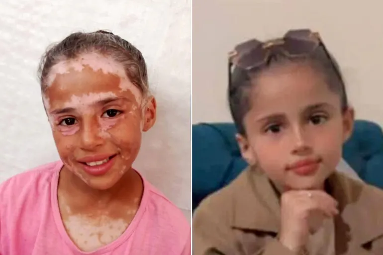لانا الشريف وجه الطفولة بغزة الذي شوهته الحرب الإسرائيلية upload image