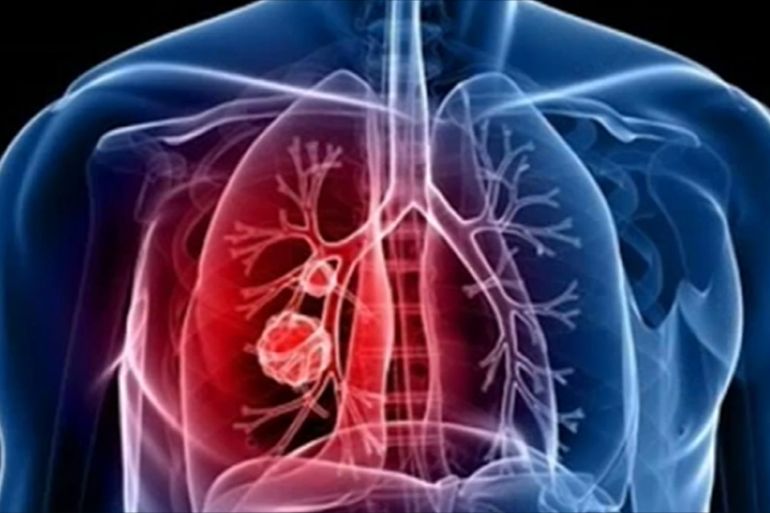 أعراض بسيطة قد تكون علامة مبكرة على سرطان الرئة upload image