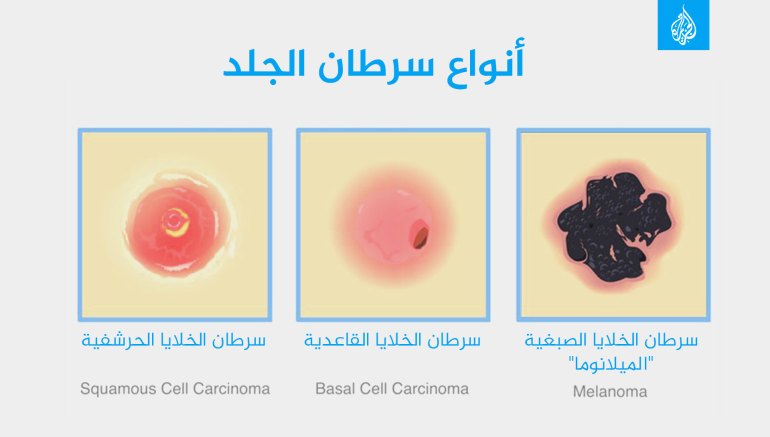 علاج يستخدم مرة واحدة يساعد مرضى سرطان الجلد على العيش مدة أطول