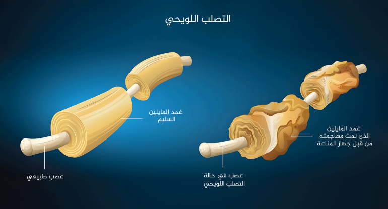 دراسة تبشر بتطوير علاجات جديدة للتصلب المتعدد