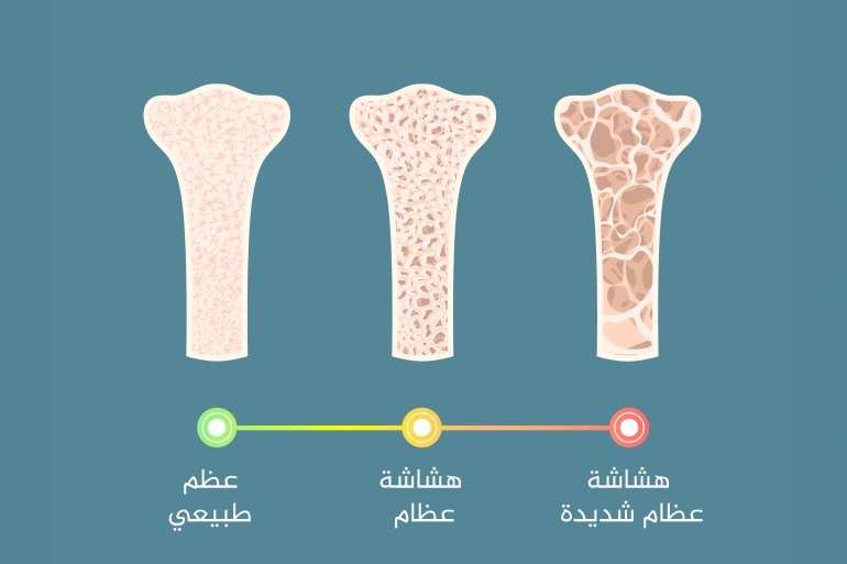 هل تشكل صحة العظام قلقا للرجال؟